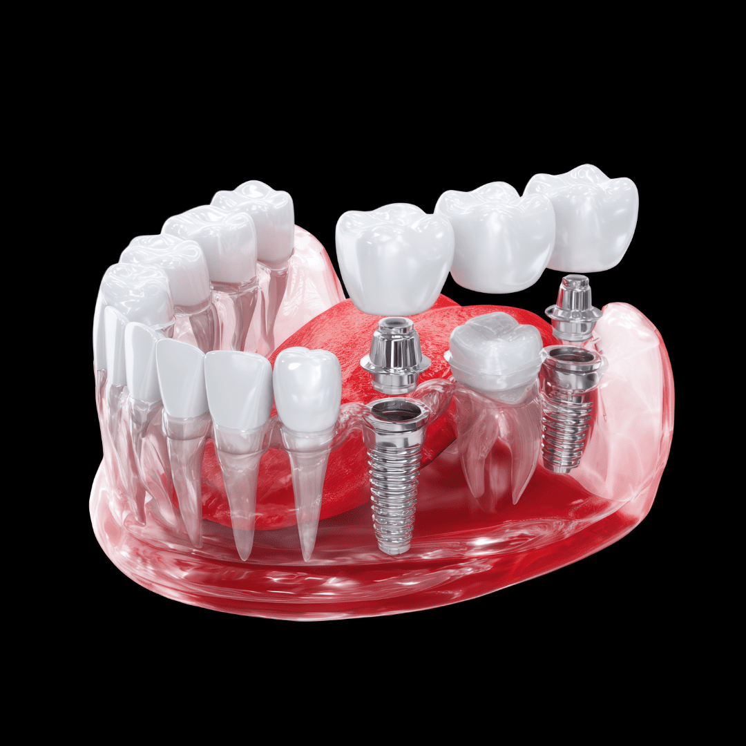 Dental Implants